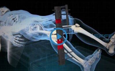 Portfolio: 3D Medical Limb Lengthening Surgery Animation Video | Medical Animation Video Services