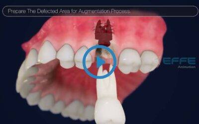 Portfolio: 3D Dental Medical Animation | Medical Animation Video Services