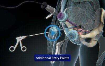 Portfolio: 3D Animation of Pelvic Laparoscopy Treatment: Medical Animation Services